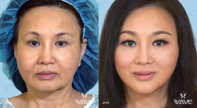 Wave Plastic Surgery