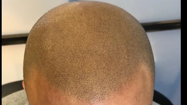 Scalp Authority 24/7 Scalp Micropigmentation Michigan Emergency