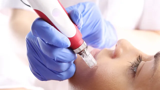 Manhattan Microneedling