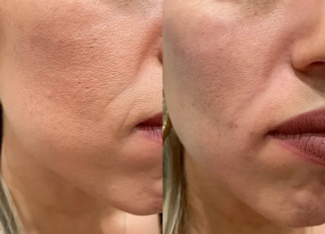 Elase Medical Spa - American Fork