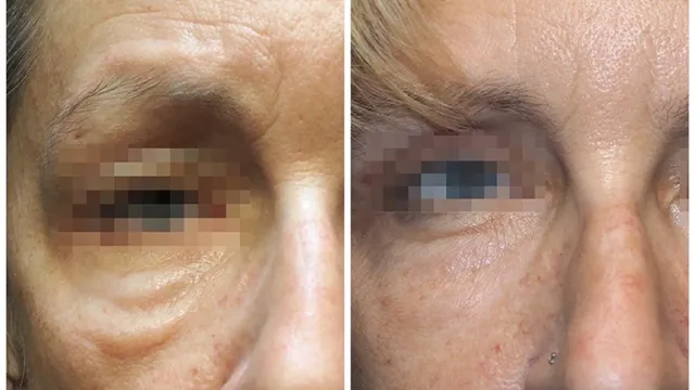 Microneedling Miami Center Morpheus8 specialists