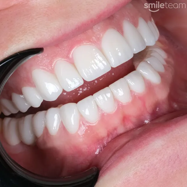 Smile Team Turkey - (Dental Implants, Crowns, Veneers & Teeth Whitening)