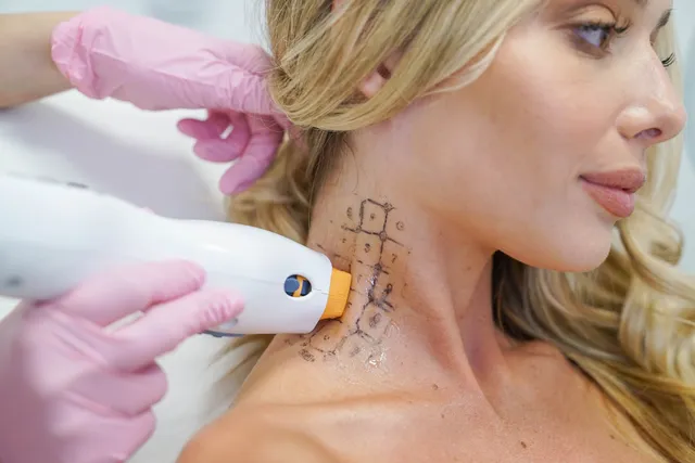 LaserAway Beverly Hills