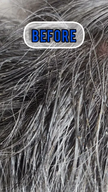 Lice Removal Service