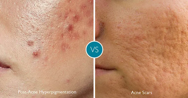 Alinea Medical Spa Acne Scar & Laser Skin Care NYC