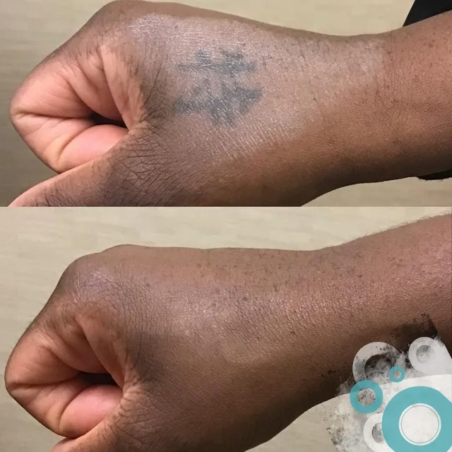 Removery Tattoo Removal & Fading