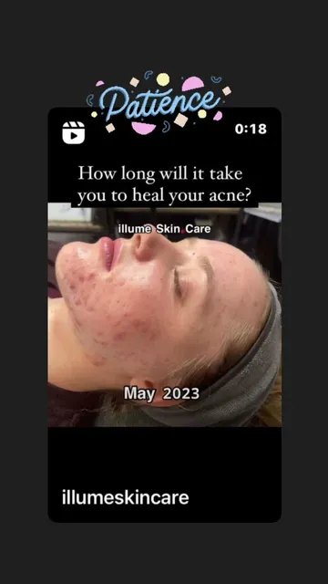 Illume Skin Care: Acne and Anti-aging Specialist Cottonwood Heights
