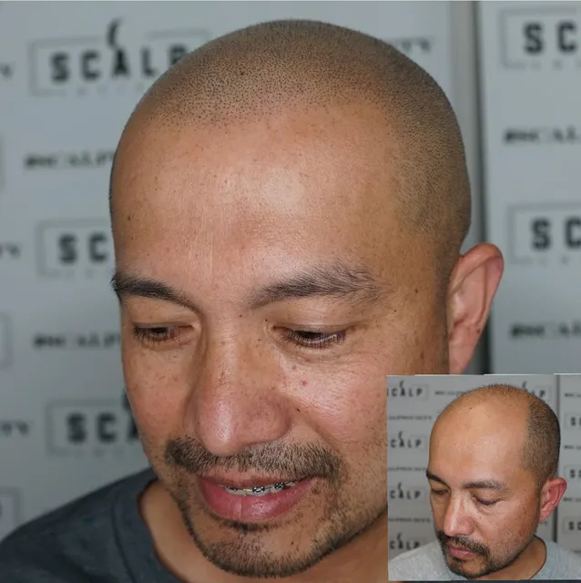 Scalp Society - Scalp Micropigmentation