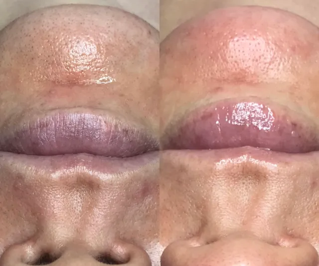 Hydrafacial and Chemical Peels by Kapri Skin
