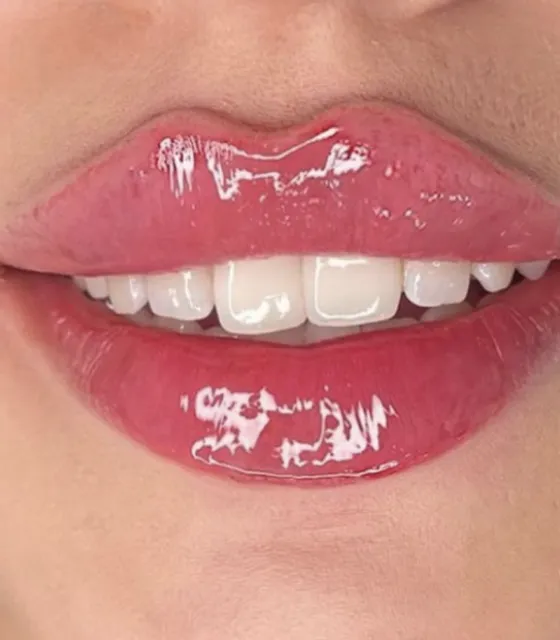 Russian Lip Fillers, medical spa, New York