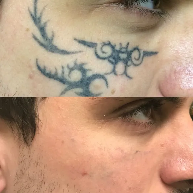 Vanishing Point Laser Tattoo Removal