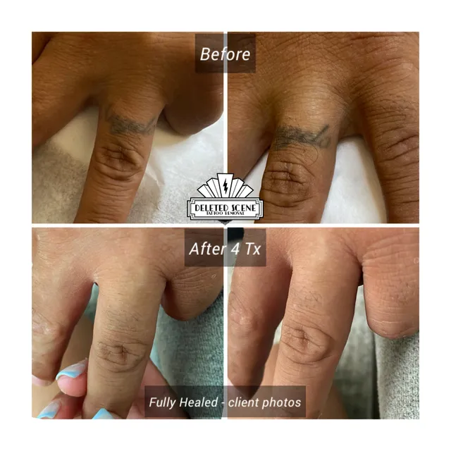 Deleted Scene Tattoo Removal