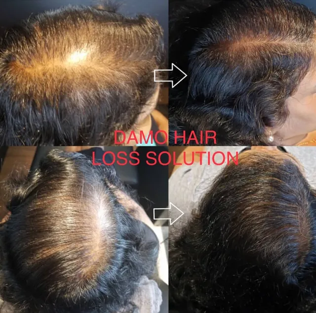 엘에이 탈모전문 클리닉 DAMO Hair Loss Solution