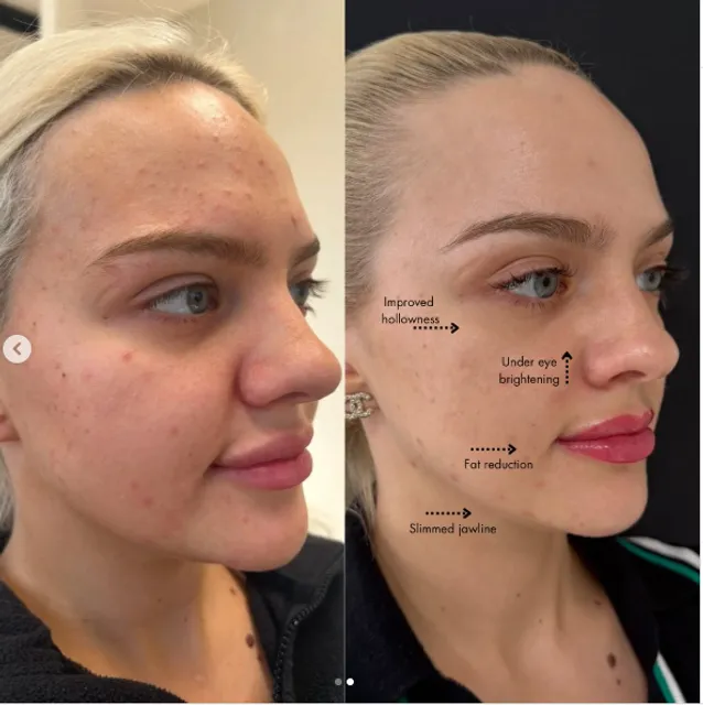 Botox + Lip fillers Los Angeles